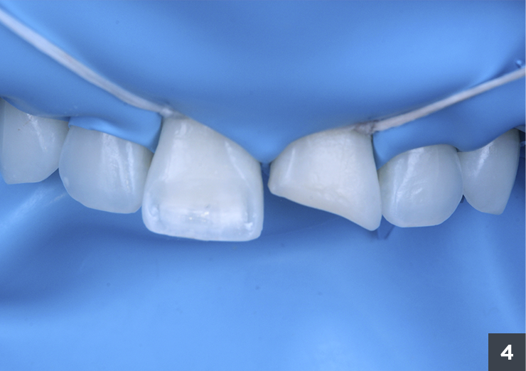 6 preparo do dente 21 e isolamento - Vittra APS - Estetica Premium