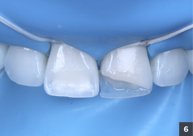 8 concha palatina vittra trans opl - Vittra APS - Estetica Premium