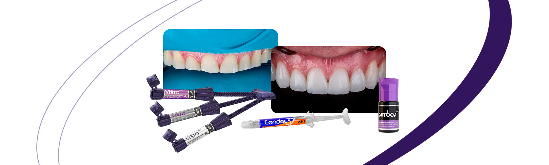 Direct veneers for rehabilitation in teeth worn by bruxism