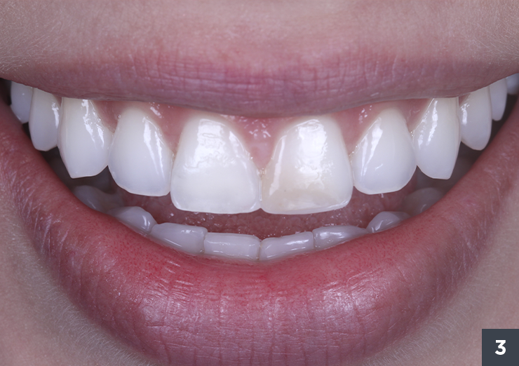DA1 e bleach - Vittra APS - Estetica Premium