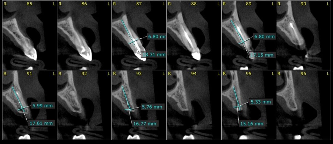 Fig 2 scaled 1 e1713464588767 - Implante Tardio com Manipulação Imediata e Uso de Cicatrizador Arcsys de Tecido Mole