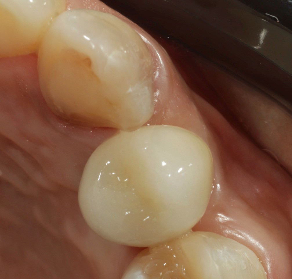 Foto 16 1 - Implante Tardio com Manipulação Imediata e Uso de Cicatrizador Arcsys de Tecido Mole