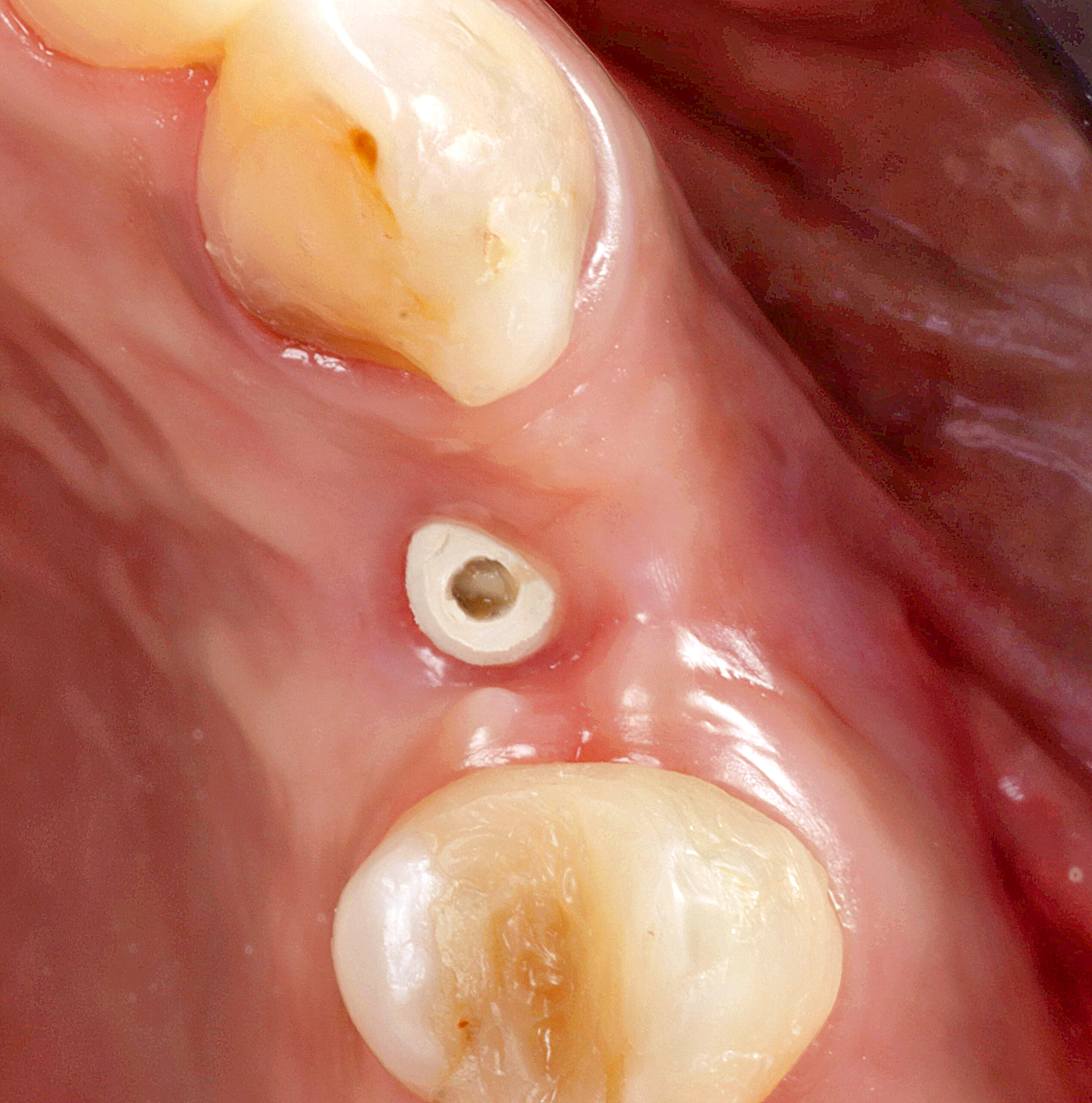 fig 11 scaled - Implante Tardio com Manipulação Imediata e Uso de Cicatrizador Arcsys de Tecido Mole