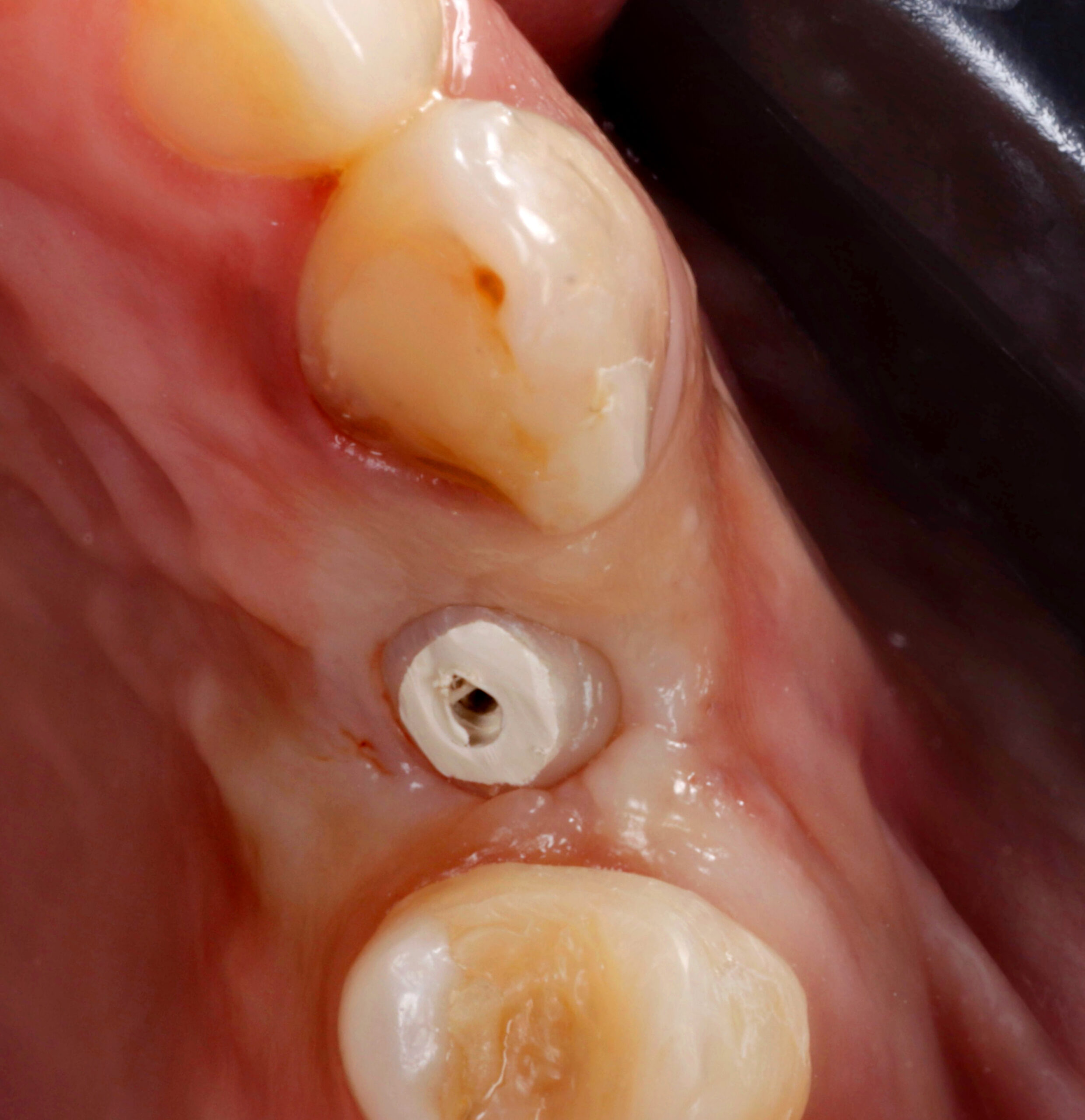 fig 13 scaled - Implante Tardio com Manipulação Imediata e Uso de Cicatrizador Arcsys de Tecido Mole
