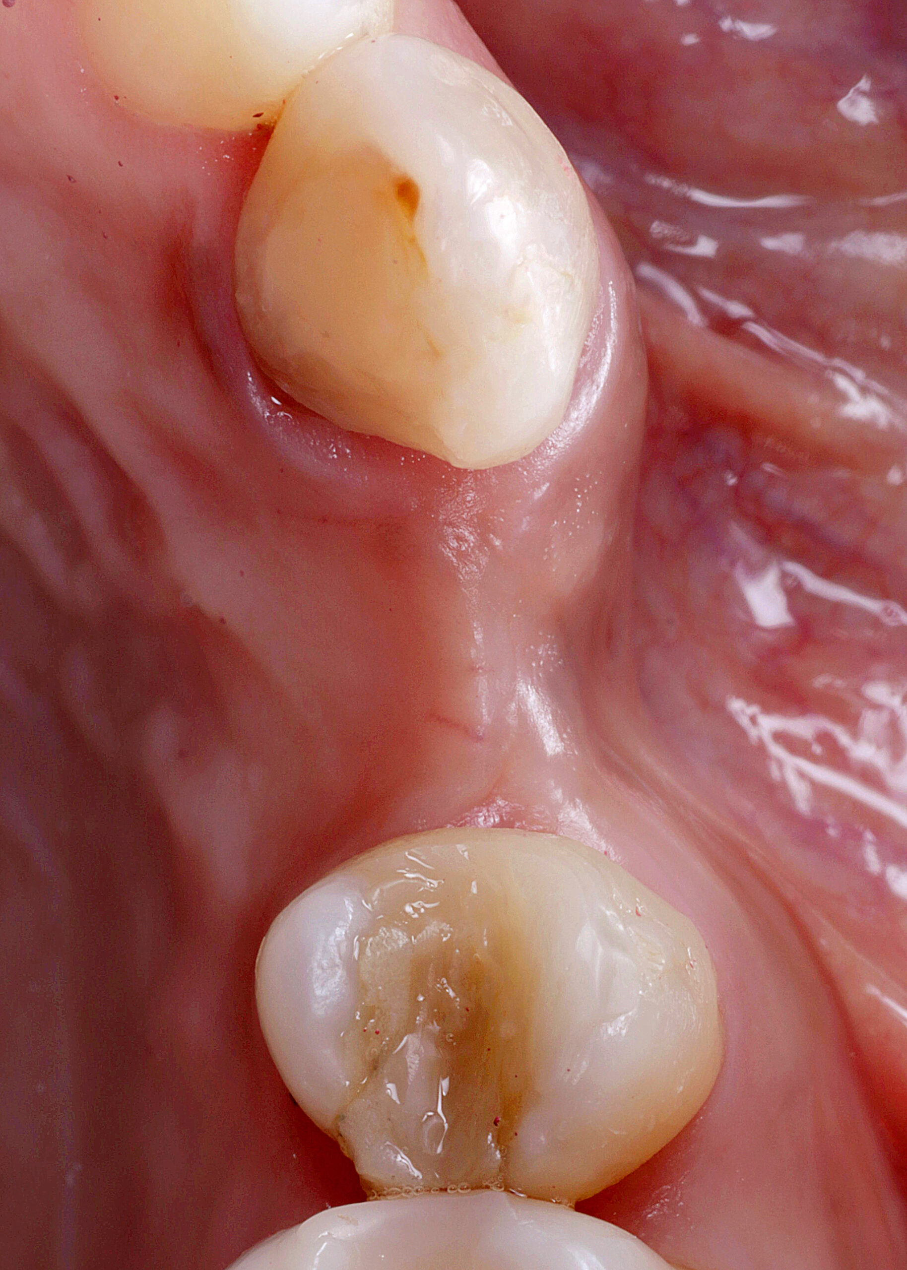 fig 4 scaled - Implante Tardio com Manipulação Imediata e Uso de Cicatrizador Arcsys de Tecido Mole