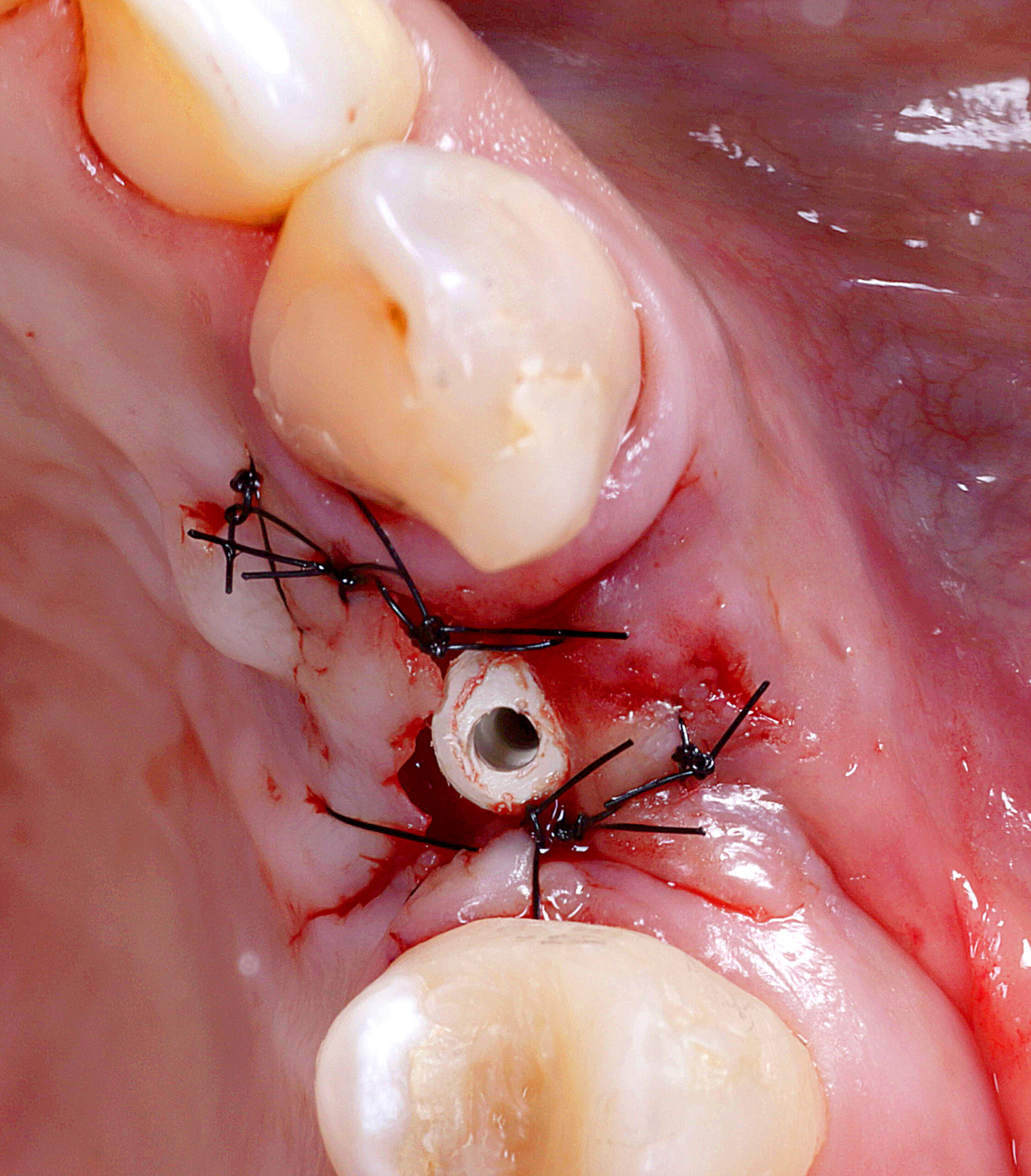 fig 6 scaled - Implante Tardio com Manipulação Imediata e Uso de Cicatrizador Arcsys de Tecido Mole