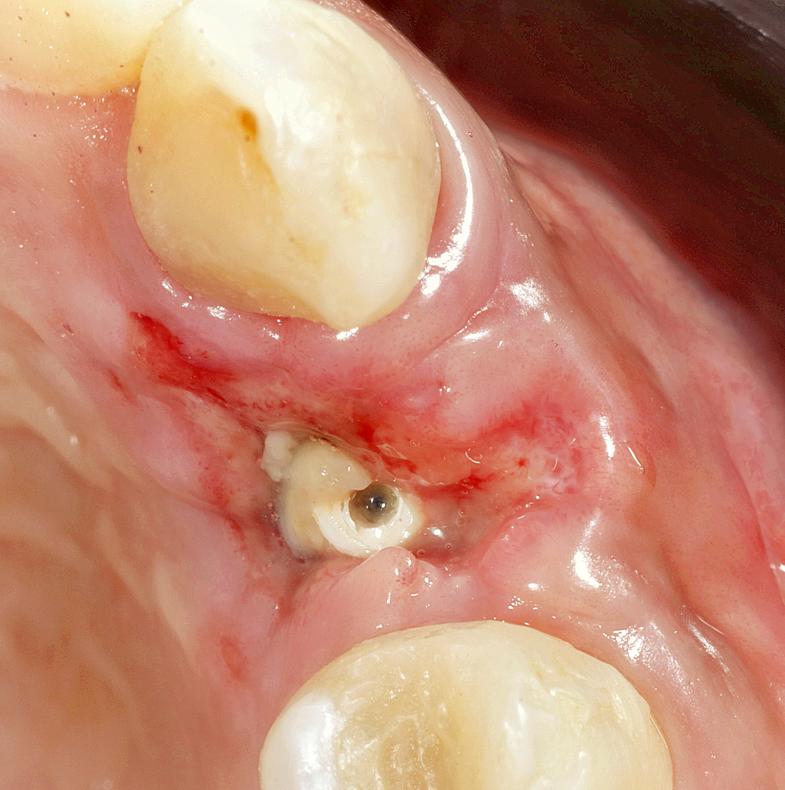 fig 9 scaled - Implante Tardio com Manipulação Imediata e Uso de Cicatrizador Arcsys de Tecido Mole