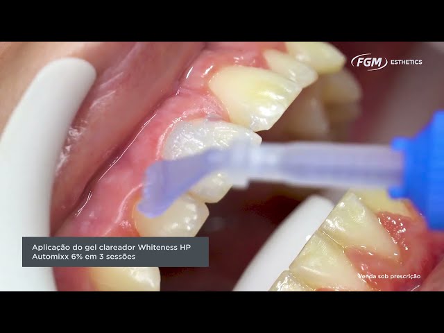Descubra o poder do Whiteness HP Automixx 6% para clareamento dental em pacientes jovens