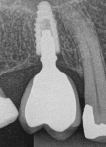 Fig. 25 Radiografia periapical - Prótesis Unitaria con Coping Friccional