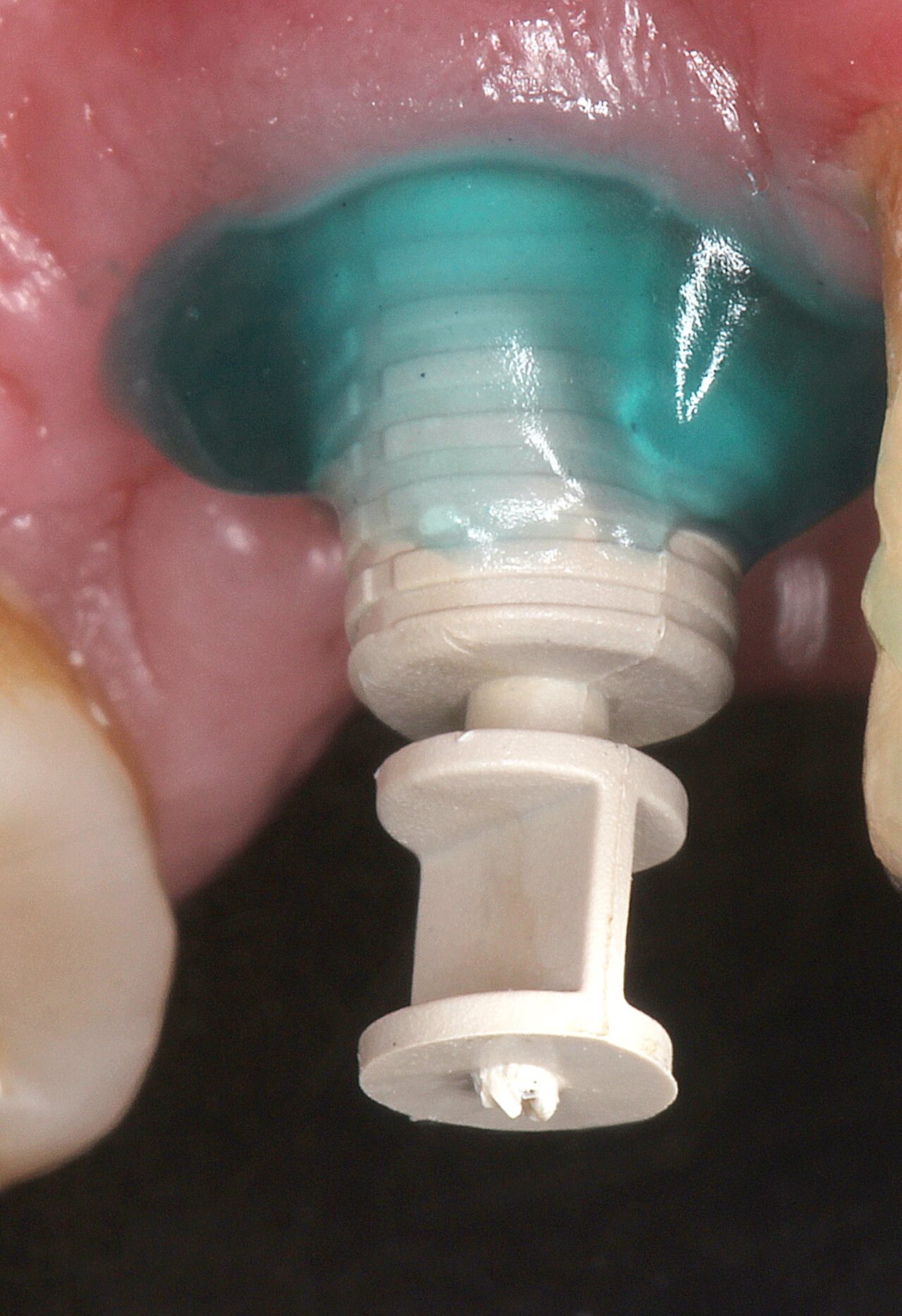 Fig. 7 Utilizacao de resina acrilica fotopolimerizavel para replicacao do tecido peri implantar condionado - Prótesis Unitaria con Coping Friccional