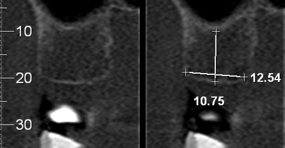 Figs. 1 e 2 Perspectivas tomograficas da regiao do elemento 16 2 - Prótesis Unitaria con Coping Friccional