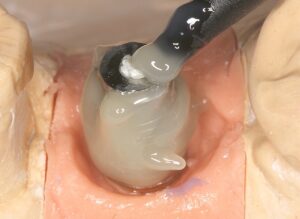 Prótesis Unitaria con Coping Friccional - FGM Dental Group