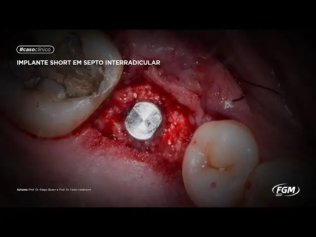 Implante short em septo interradicular
