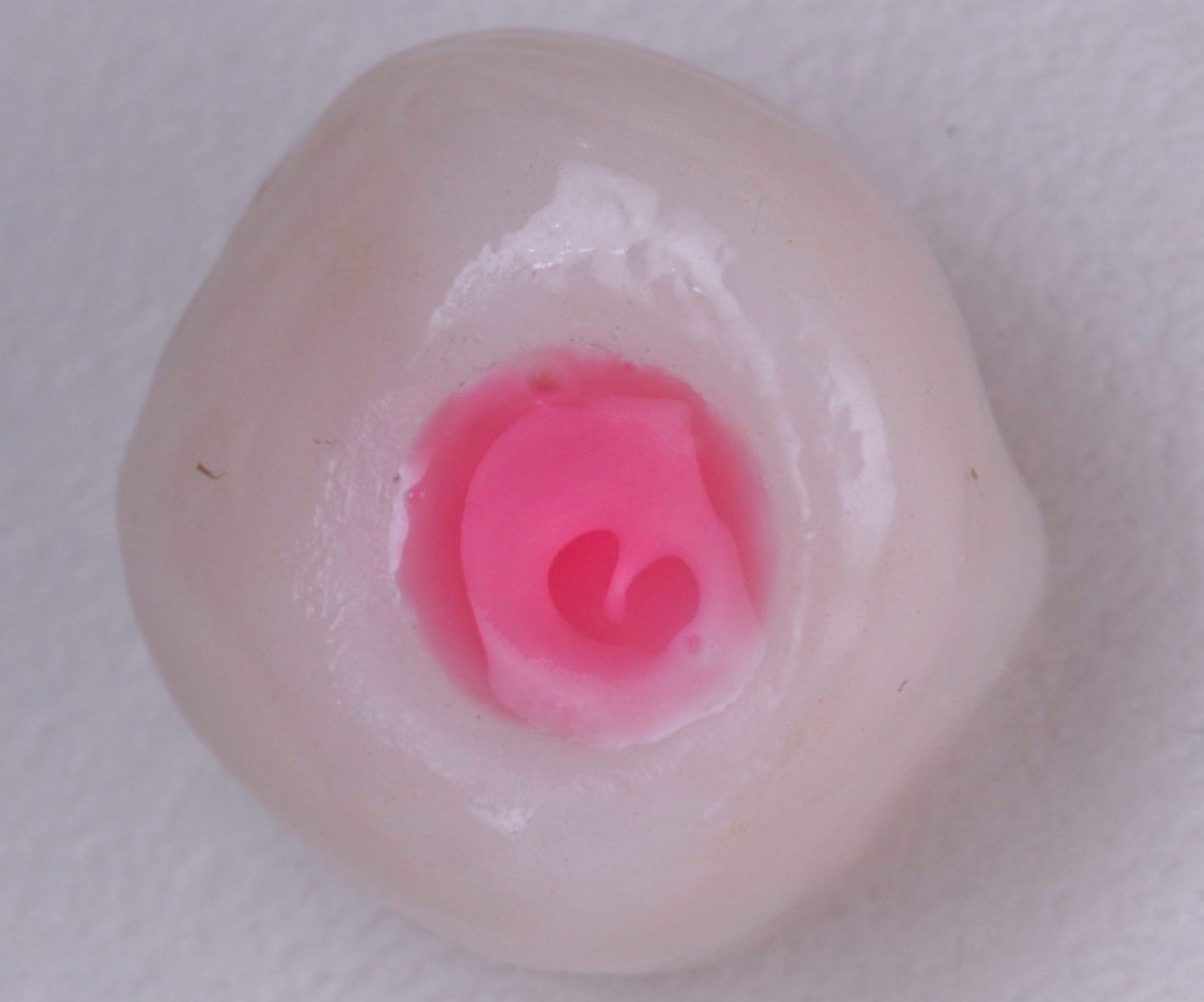 Acido fluoridrico scaled e1705673885565 - Implante Imediato Arcsys em molar inferior