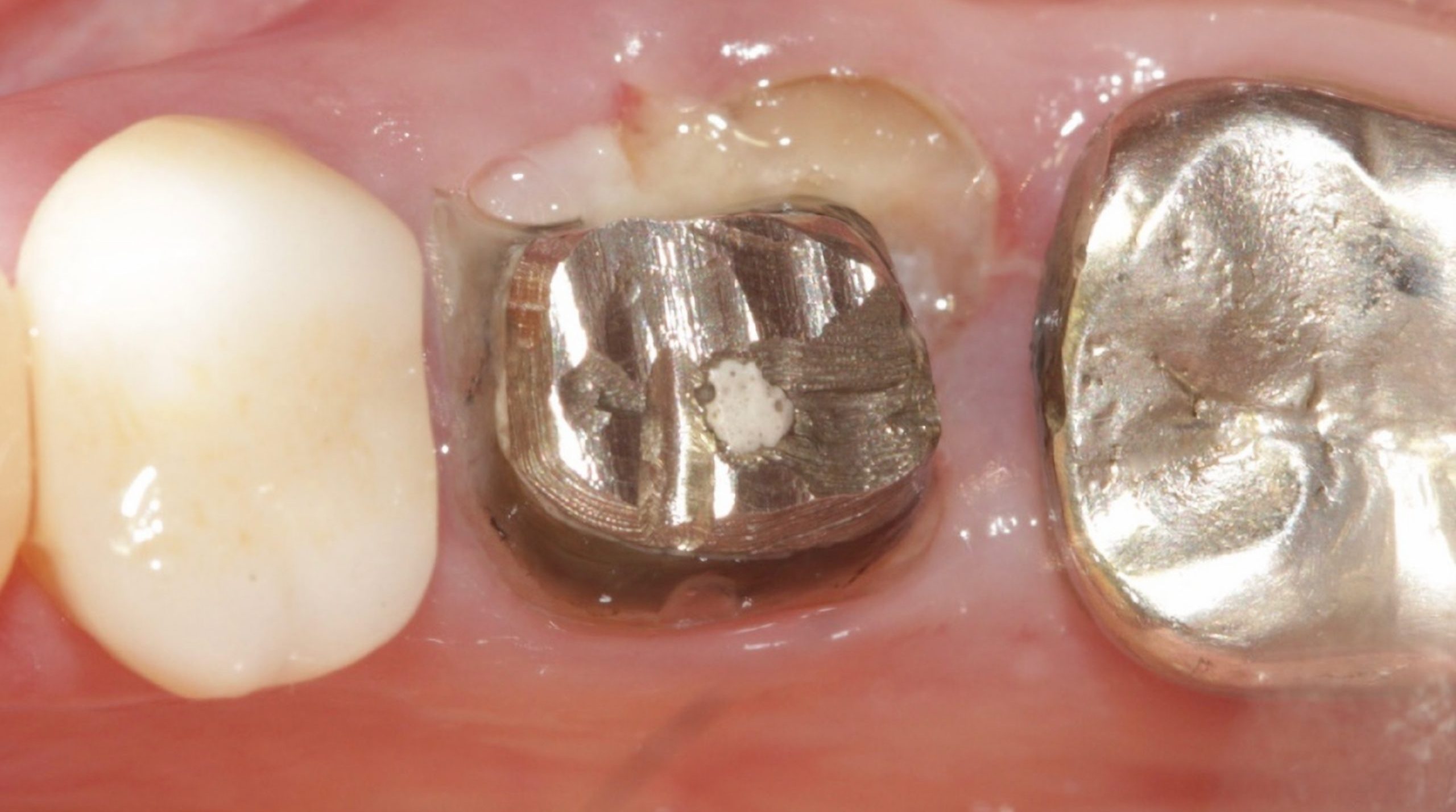 Aspecto inicial scaled e1705675530893 - Implante Imediato Arcsys em molar inferior
