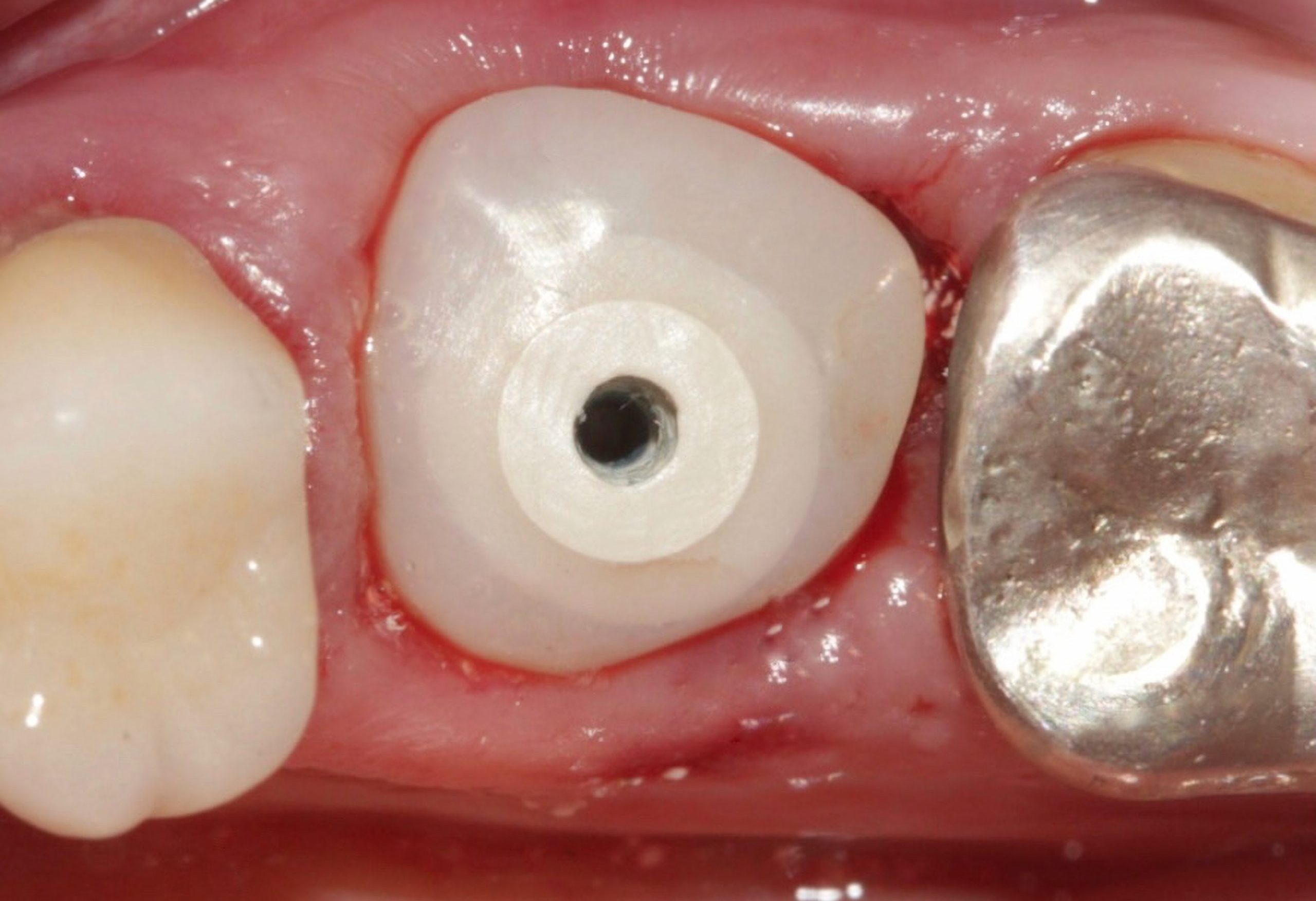 Cicatrizador instalado scaled e1705670986548 - Implante Imediato Arcsys em molar inferior