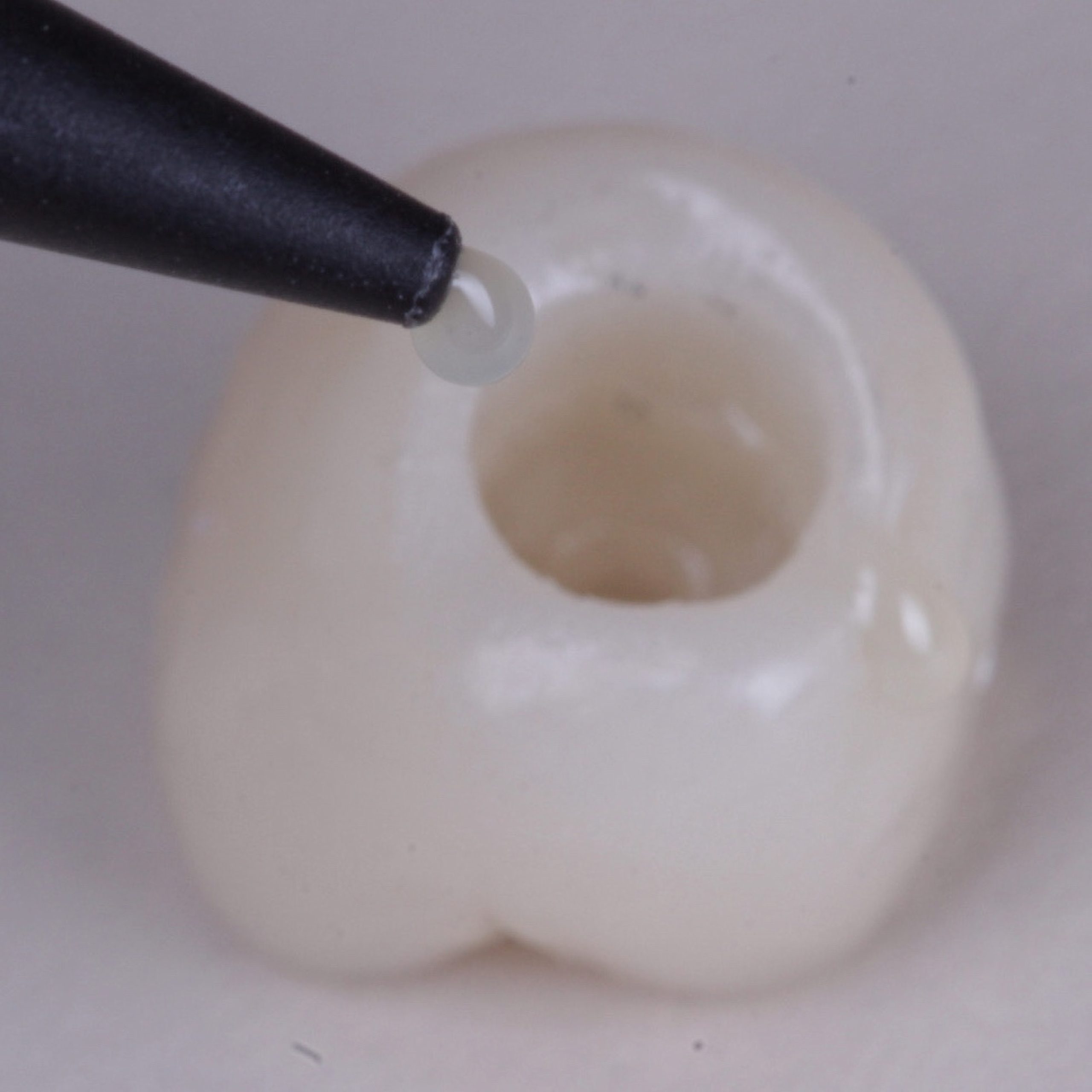 Cimento autoadesivo scaled - Implante Imediato Arcsys em molar inferior