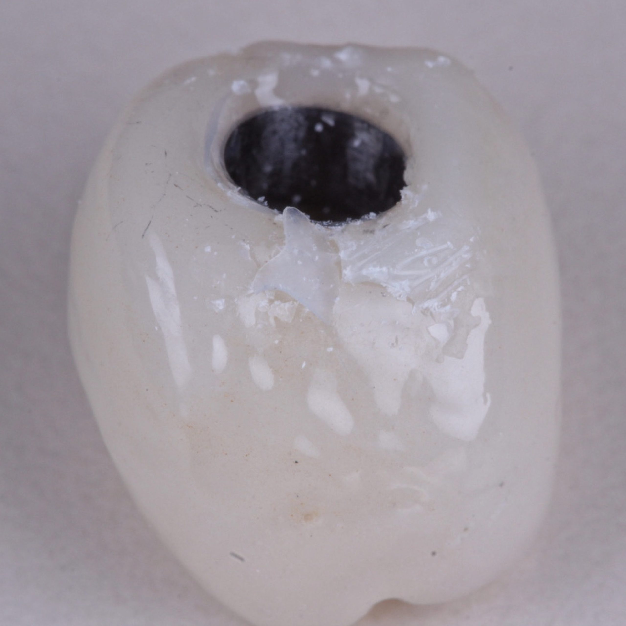Excesso de cimento scaled - Implante Imediato Arcsys em molar inferior