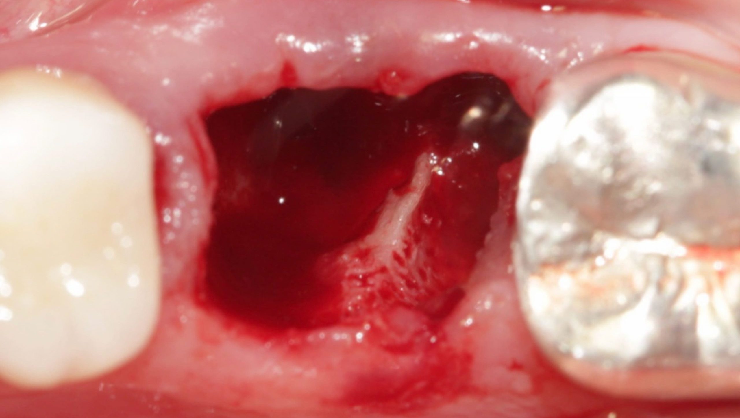 Exodontia scaled e1705603736311 - Implante Imediato Arcsys em molar inferior