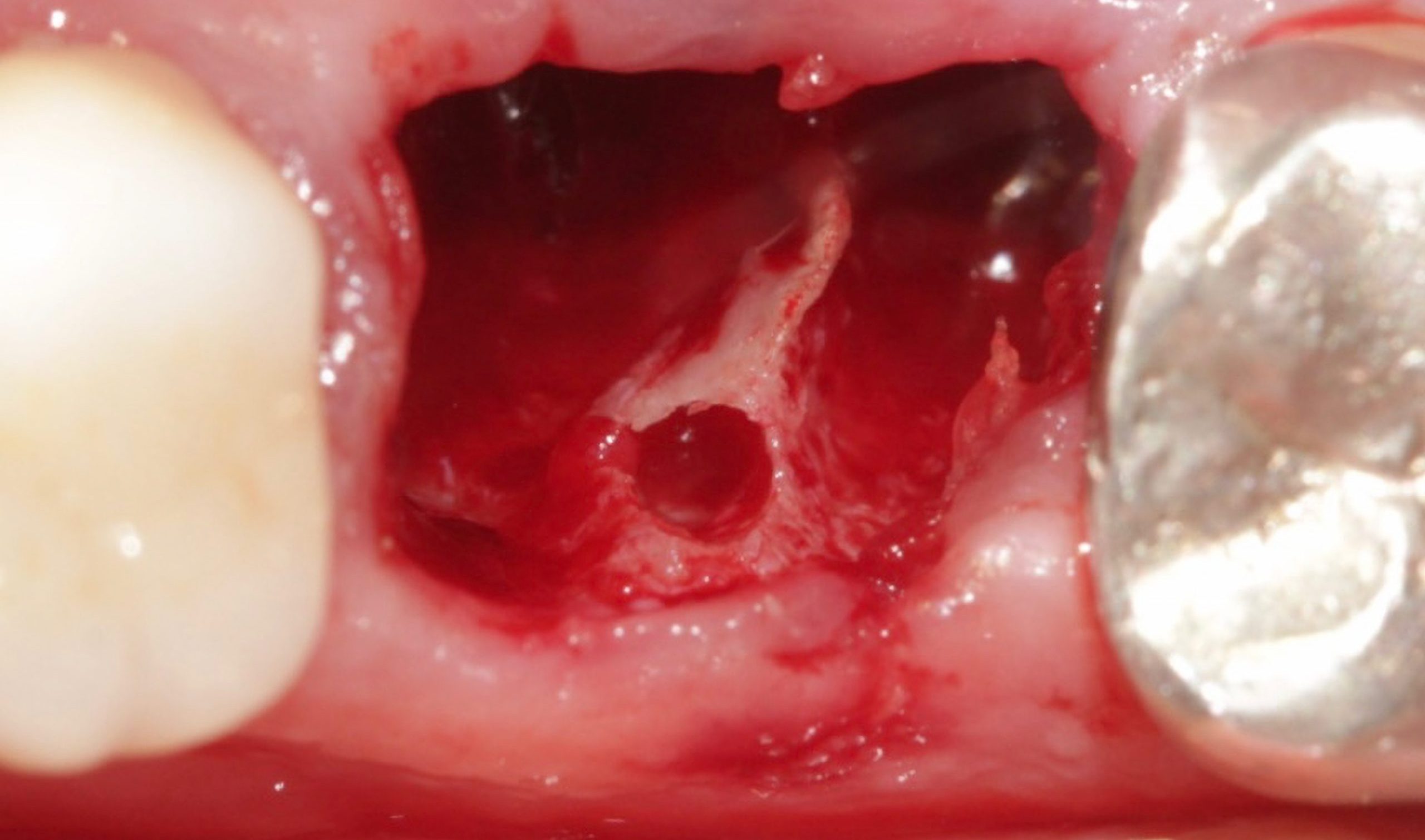 Expansao scaled e1705662674161 - Implante Imediato Arcsys em molar inferior