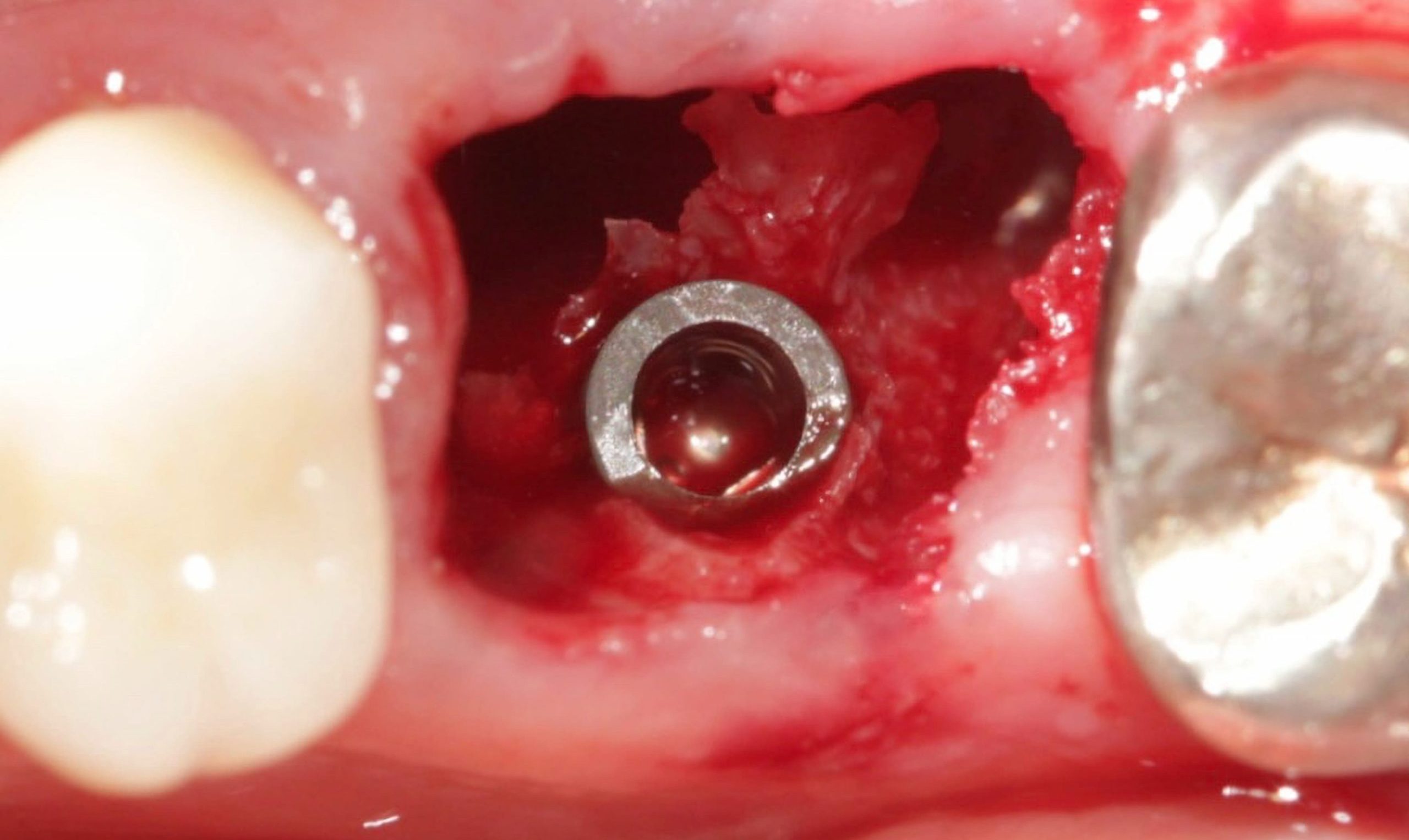 Inst implante scaled e1705662746181 - Implante Imediato Arcsys em molar inferior