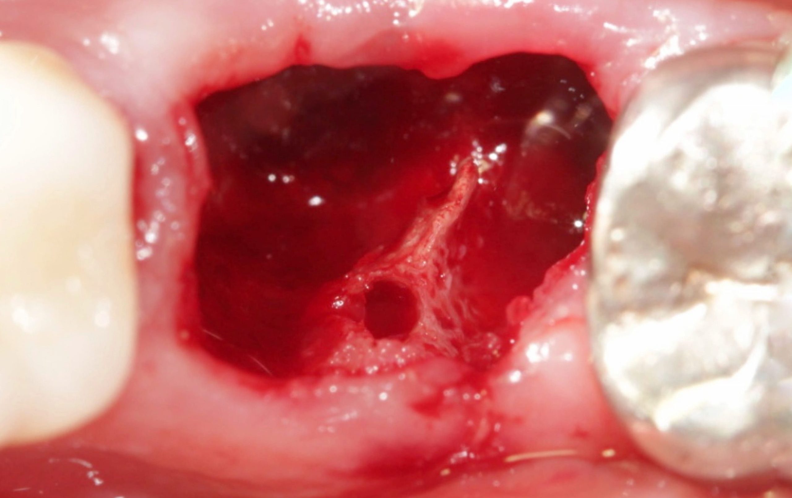 Lanca scaled e1705605918181 - Implante Imediato Arcsys em molar inferior