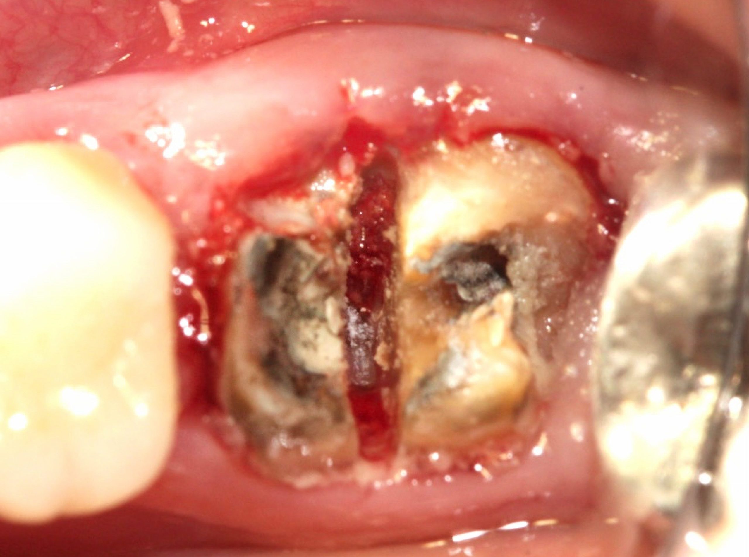 Odontoseccao scaled e1705601349806 - Implante Imediato Arcsys em molar inferior