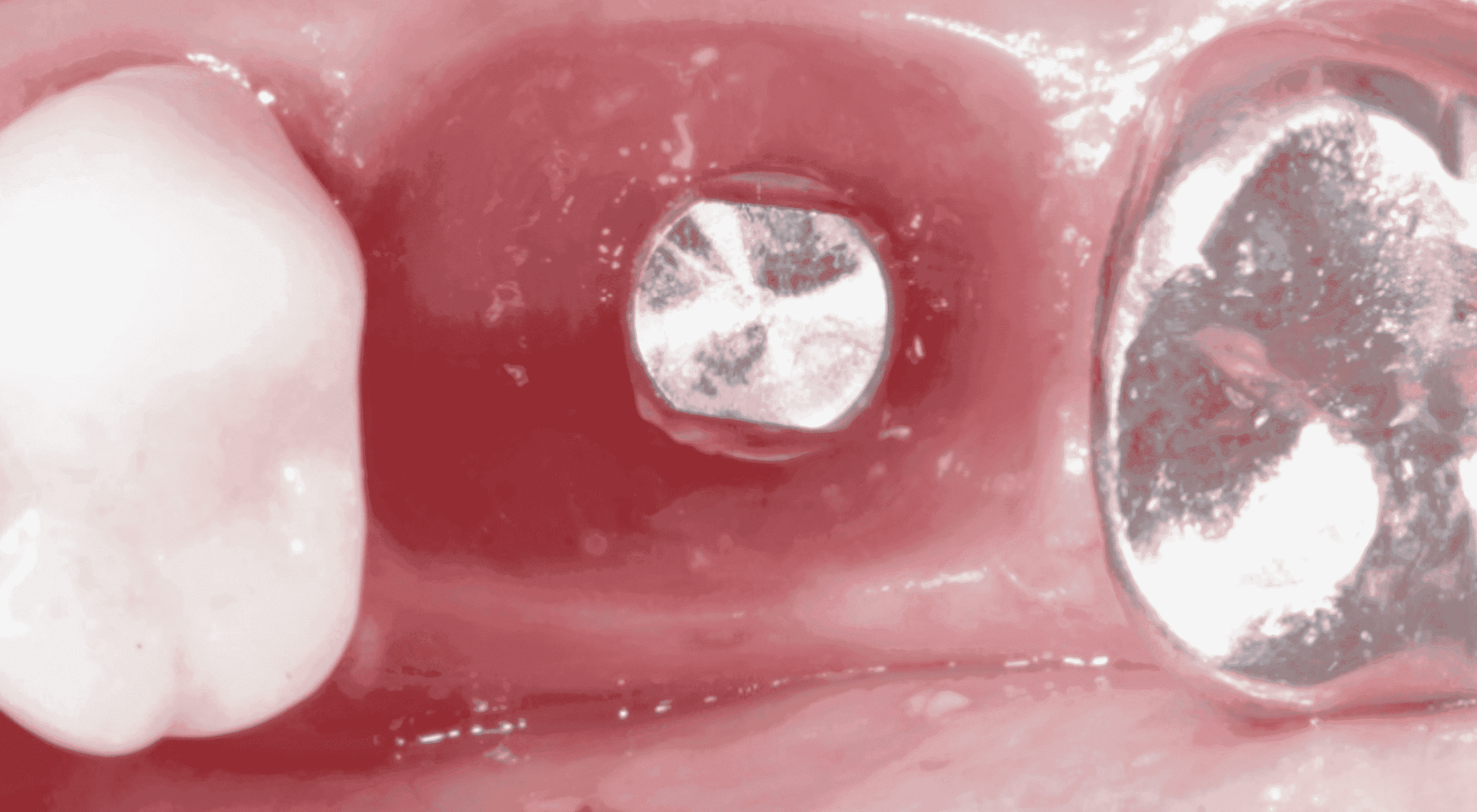 Perfil de emergencia 1 1 1 1 1 1 1 1 1 e1705672039192 - Implante Imediato Arcsys em molar inferior