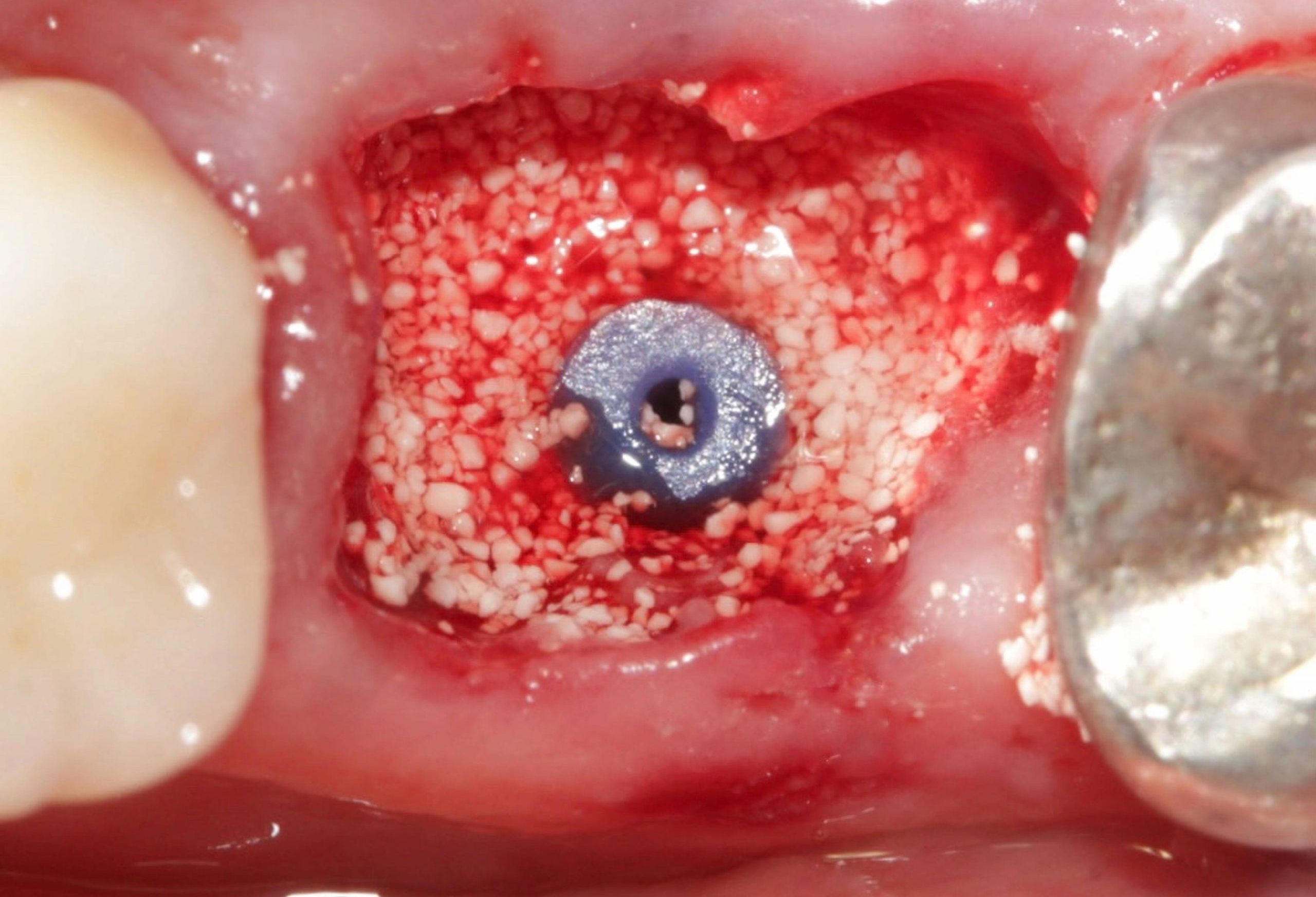 Prrench gap scaled e1705670439923 - Implante Imediato Arcsys em molar inferior