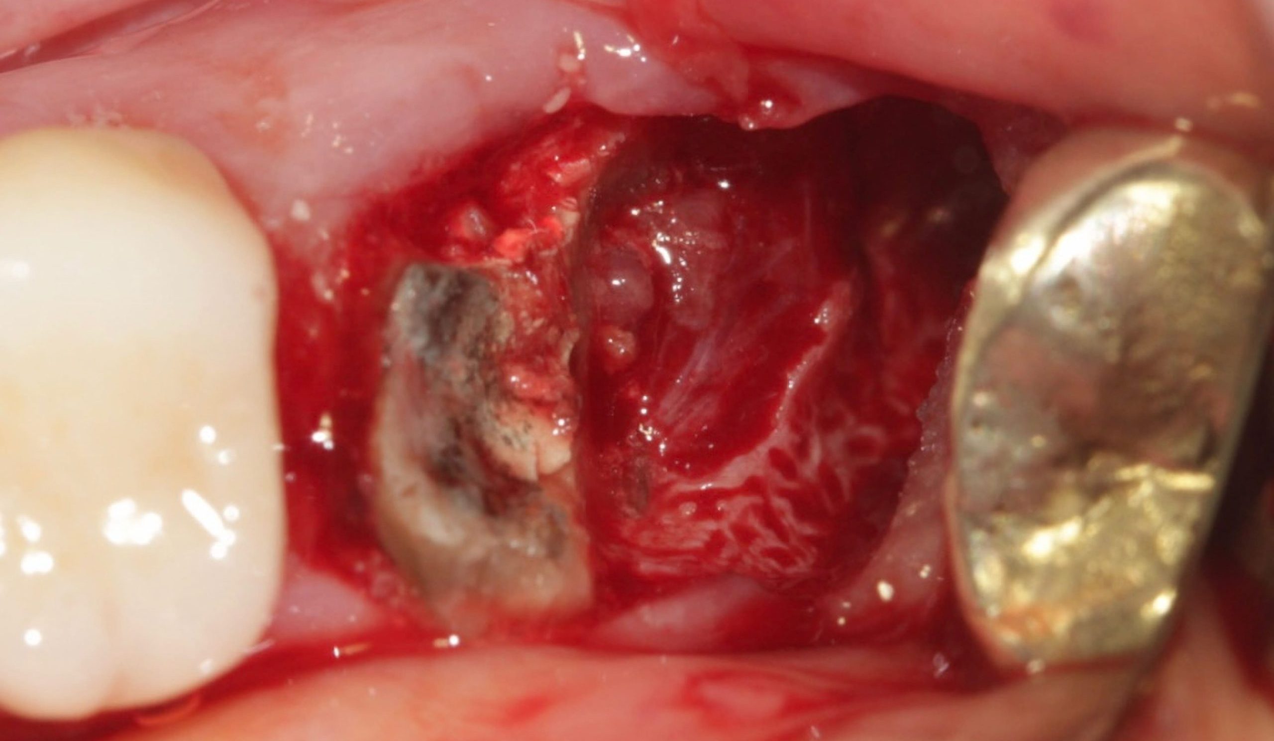Rem raiz distal scaled e1705603326630 - Implante Imediato Arcsys em molar inferior