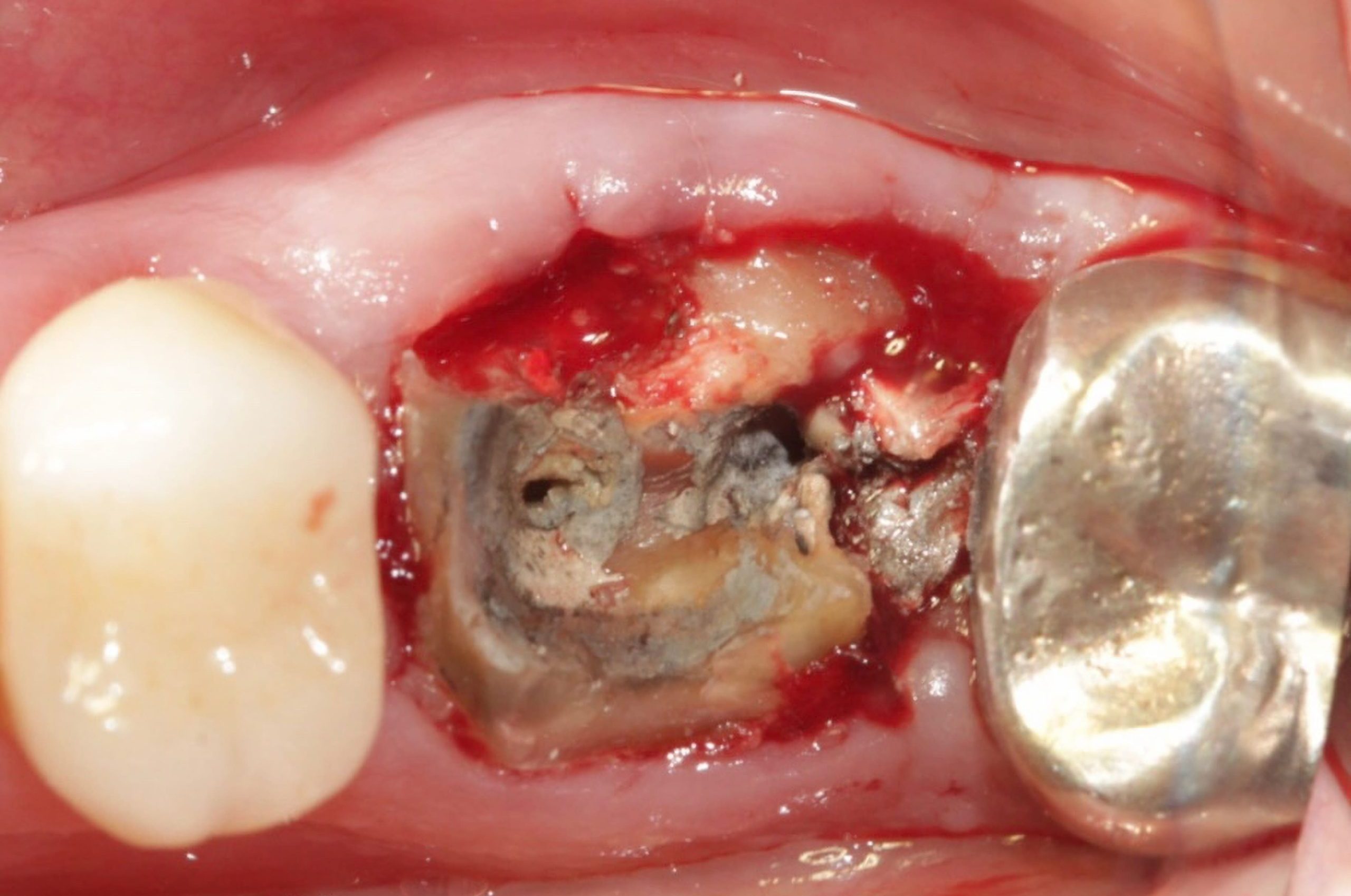 Remocao do NMF 1 scaled e1705587328935 - Implante Imediato Arcsys em molar inferior