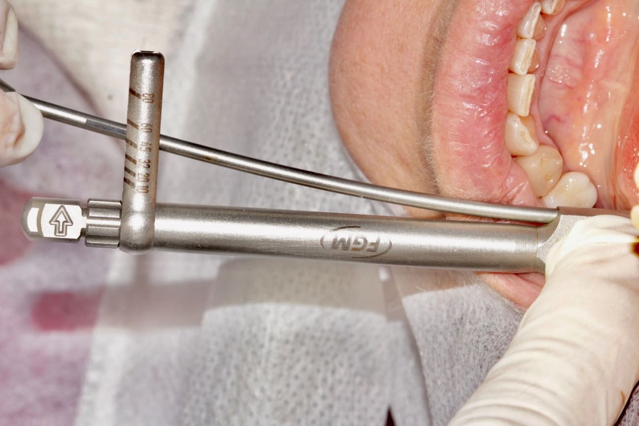 image11 - Implante Imediato Arcsys em molar inferior