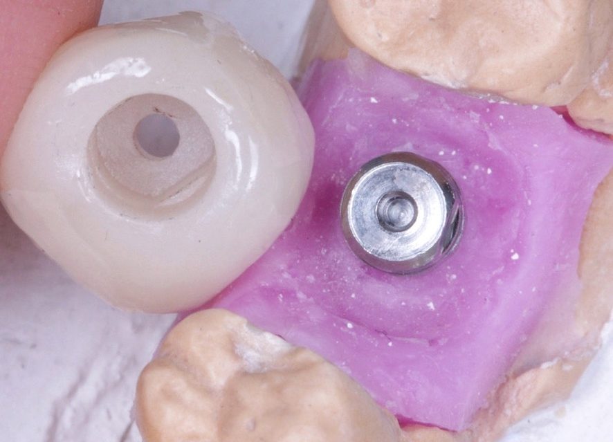 image19 e1705673652614 - Implante Imediato Arcsys em molar inferior