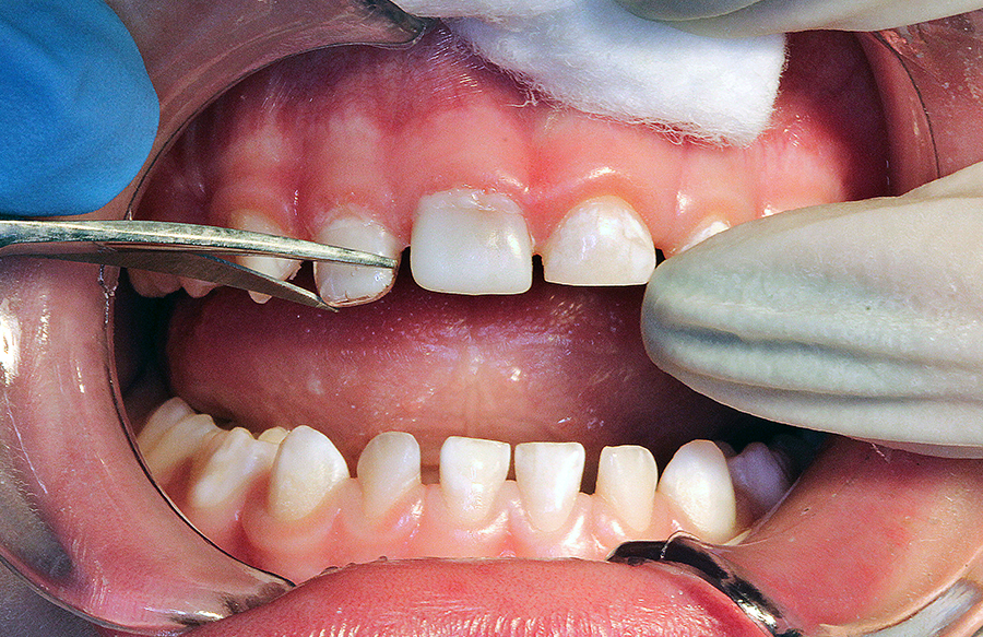4 | Posicionando a coroa de acetato preenchida com a resina Vittra APS Unique e fotoativação do dente 52.