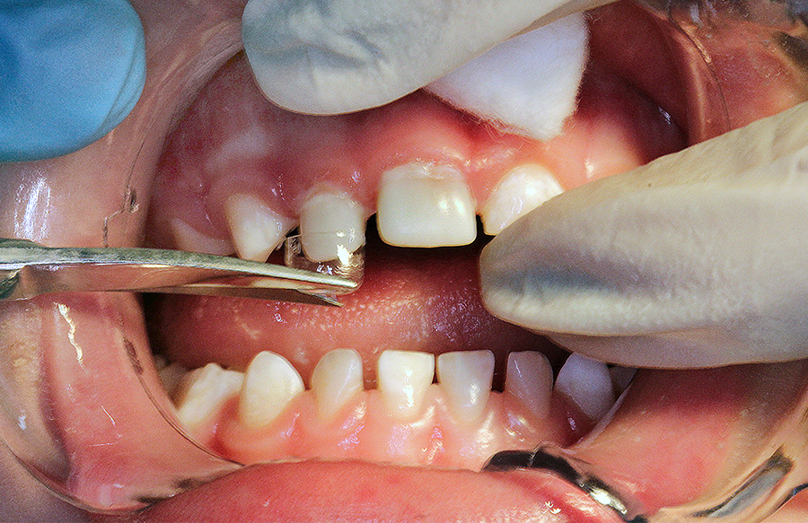 5 | Removendo a coroa de acetato após fotoativação do dente 52.