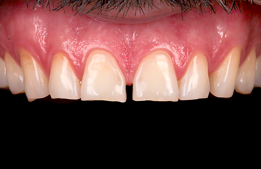 1 | O sorriso inicial. É possível visualizar um grau elevado de desgaste nos dentes e a presença de um diastema entre os incisivos centrais superiores.