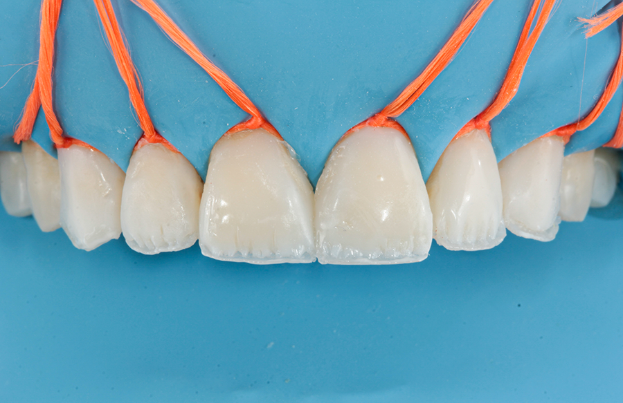 5 | Camada de dentina já posicionada sobre o dente, respeitando um volume natural e a reprodução dos mamelos.