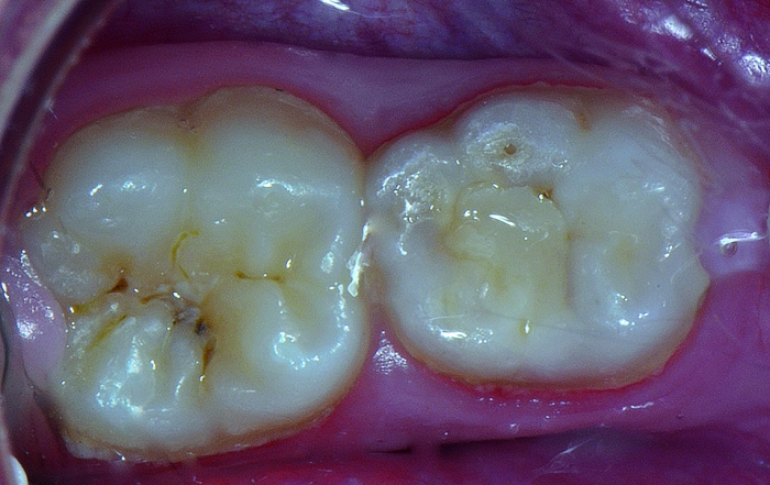 Aspecto inicial, após profilaxia prévia do dente 46