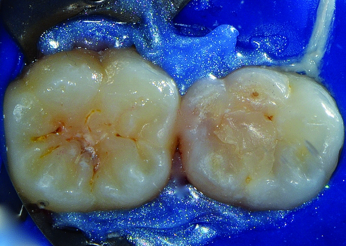 Isolamento absoluto do dente 46, utilizando o grampo 14 e vedamento com auxílio de barreira gengival