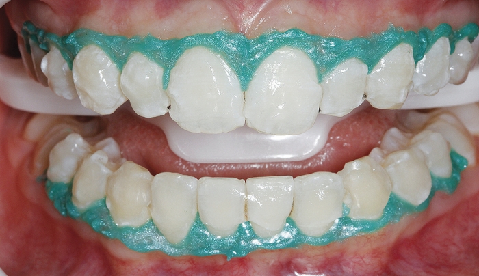Colocação do bráquete na superfície dental em uma posição primária. Como Orthocem (FGM) possui primer em sua composição, não há necessidade da aplicação de adesivo no dente previamente a esta etapa