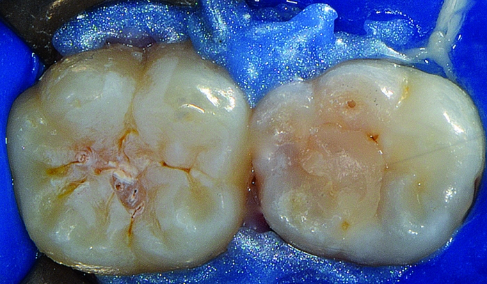07 - Selante resinoso invasivo em fóssulas e fissuras de molares de paciente com risco ao desenvolvimento de lesões de cárie