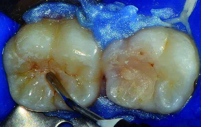 10 - Selante resinoso invasivo em fóssulas e fissuras de molares de paciente com risco ao desenvolvimento de lesões de cárie