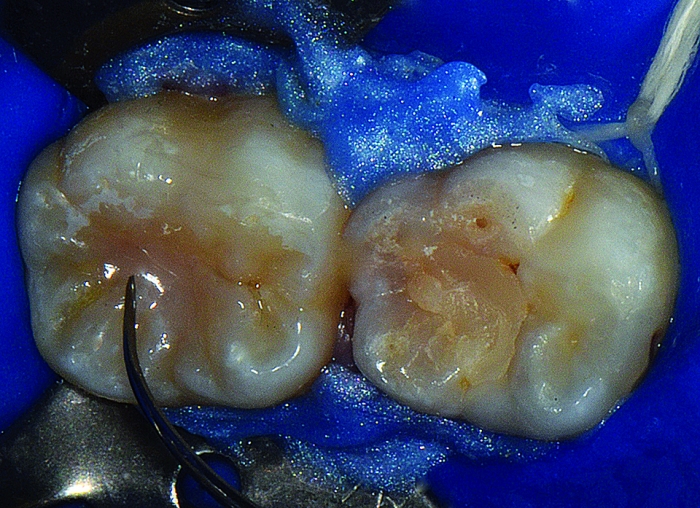 12 - Selante resinoso invasivo em fóssulas e fissuras de molares de paciente com risco ao desenvolvimento de lesões de cárie