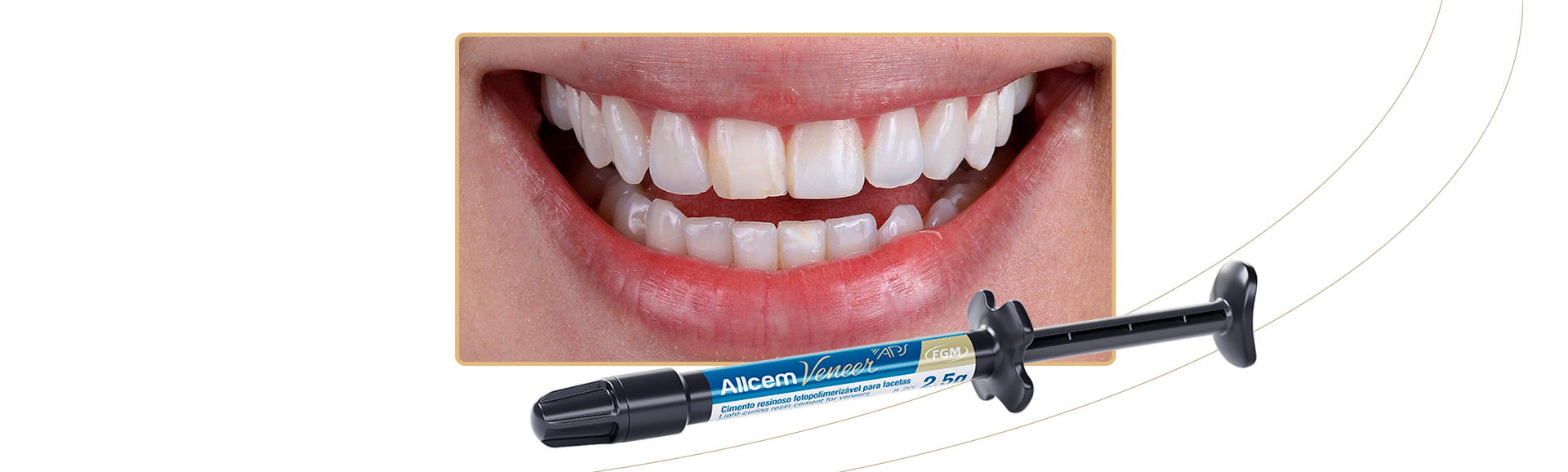 13_Capa-Facetas-cerâmicas-em-incisivos-centrais-superiores