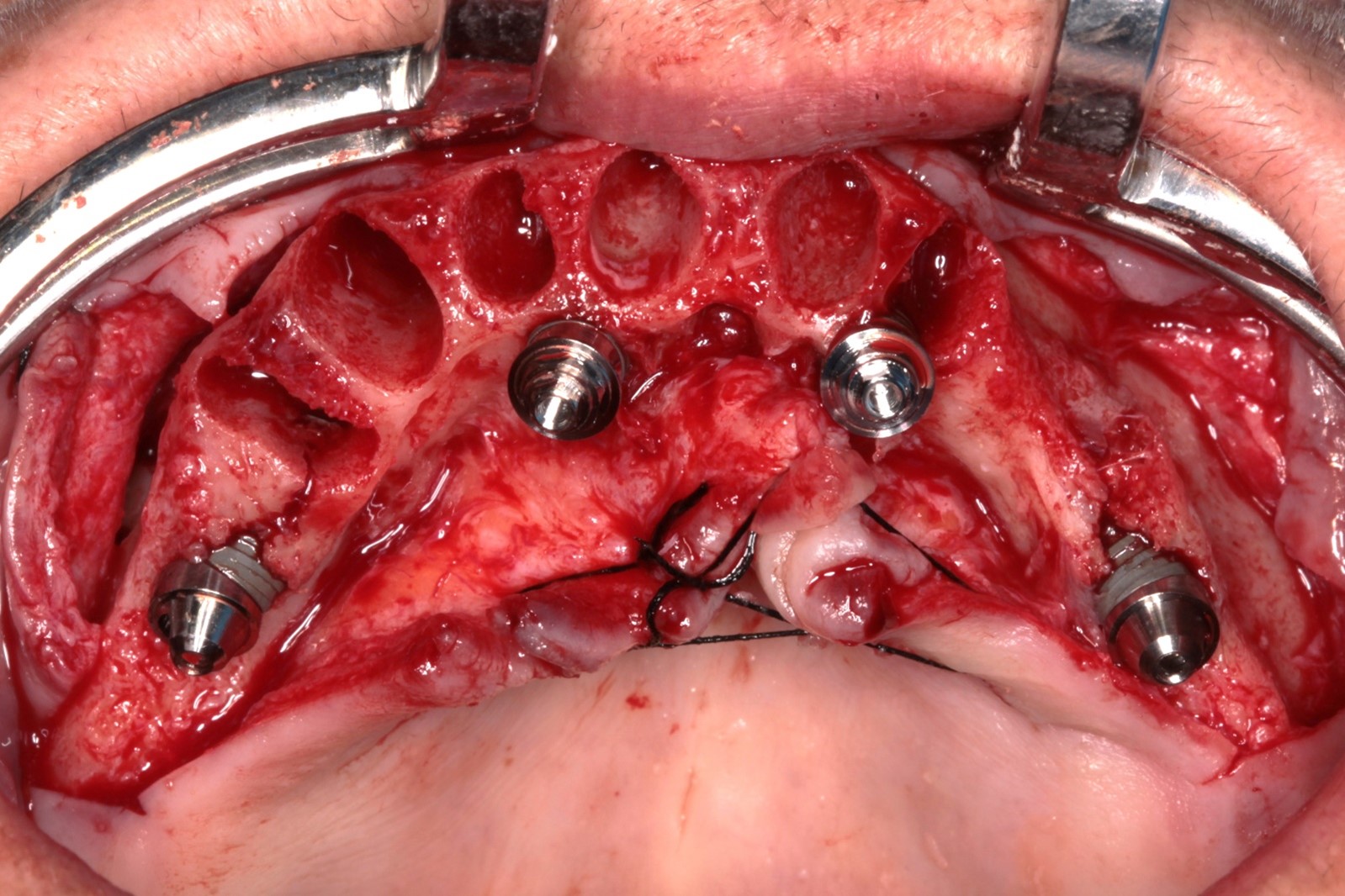 reabilitação de maxila