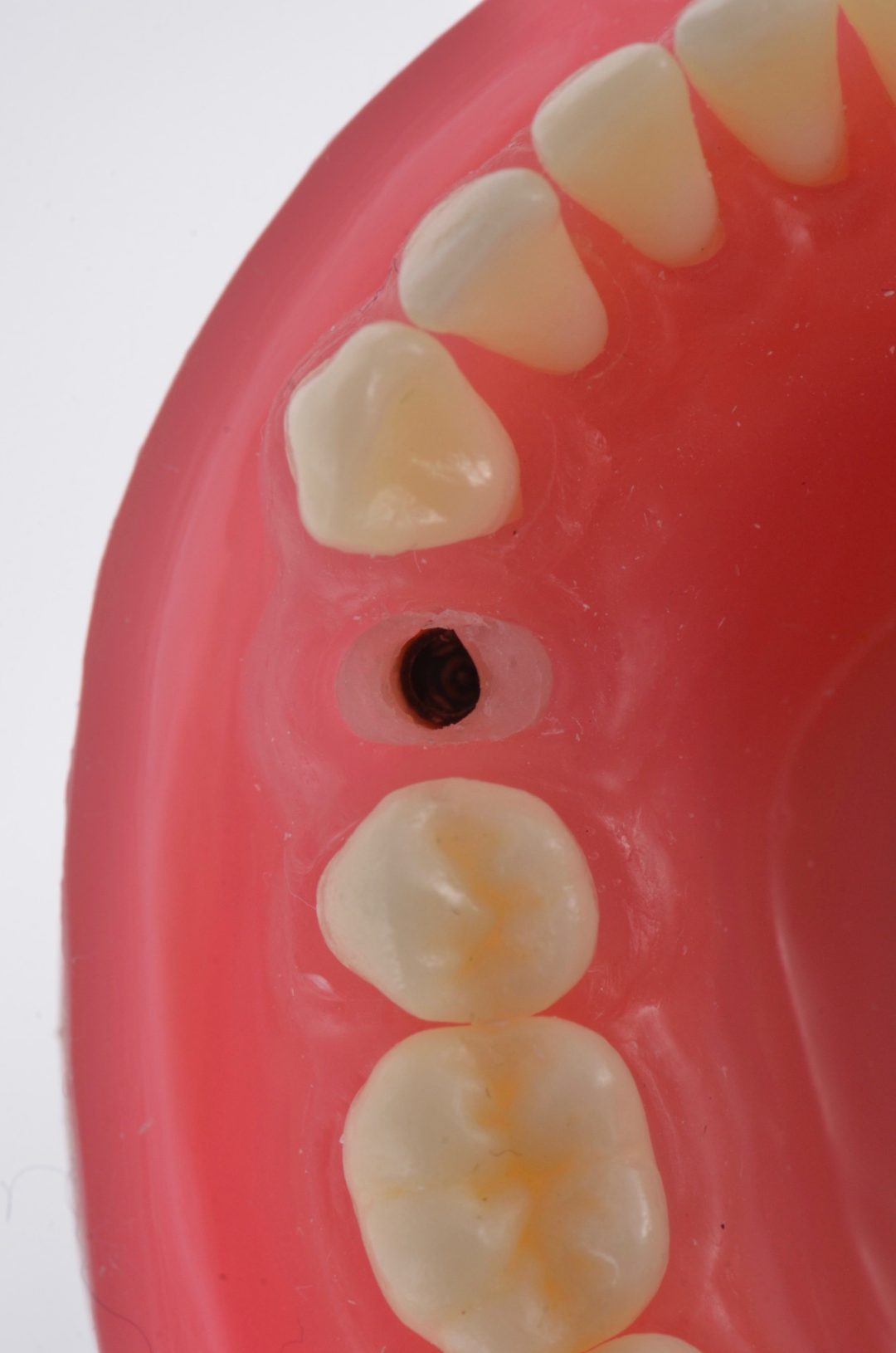 Fig. 1 - Vista oclusal de implante Arcsys, na região do 34