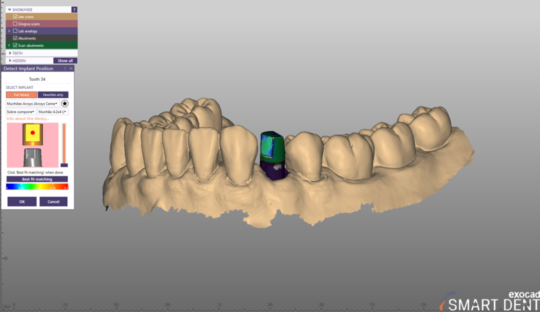 Fig. 10 - Referencie o posicionamento do scan body no software