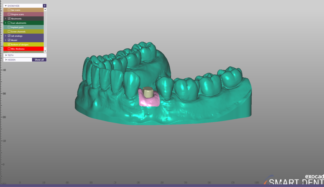 Fig. 11 - No caso da necessidade de um modelo físico para condução da fase protética, crie e imprima um modelo de trabalho