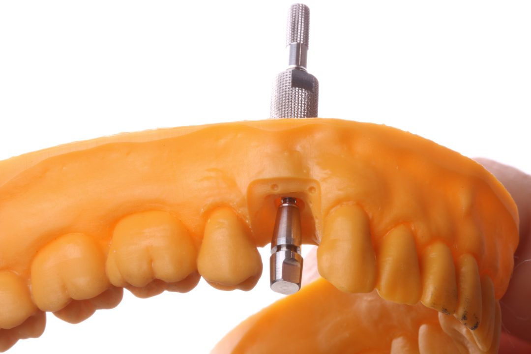 Fig. 14b - Rosqueie o pino do Montador no análogo digital