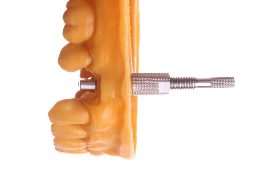 Fig. 14c - Rosqueie o corpo do Montador até que o análogo clique no modelo impresso